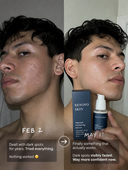 Pigment Perfecting Serum - Before & After | Renovo Skin